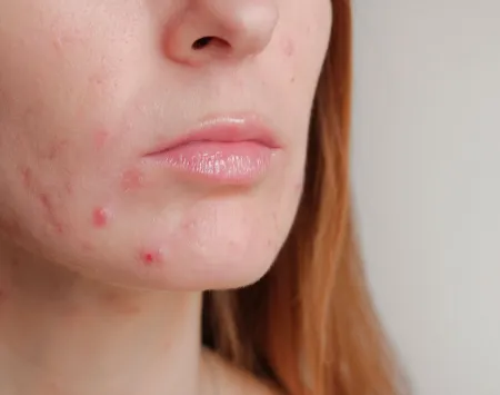 sebium_maskne_acne-women